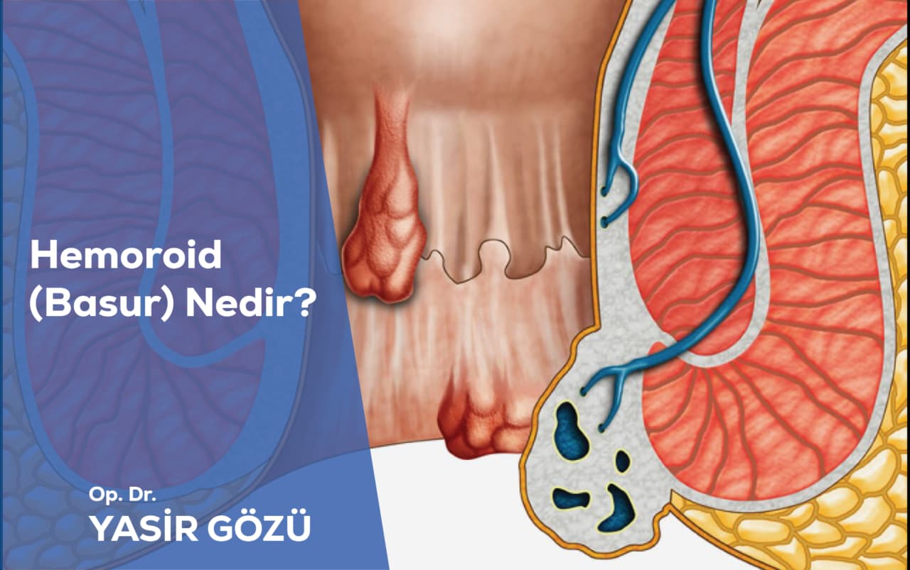 hemoroid basur nedir