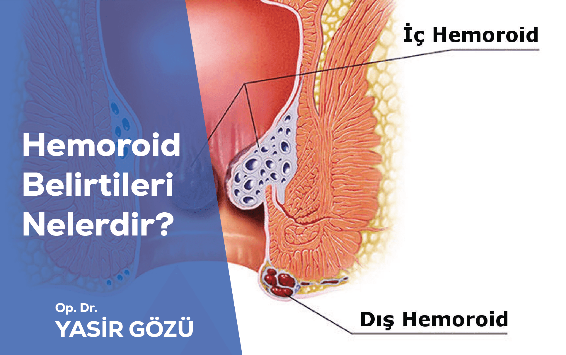hemoroid belirtileri